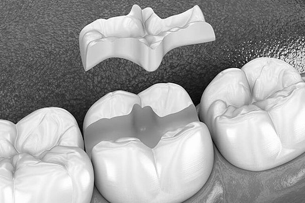 inlays-onlays.jpg